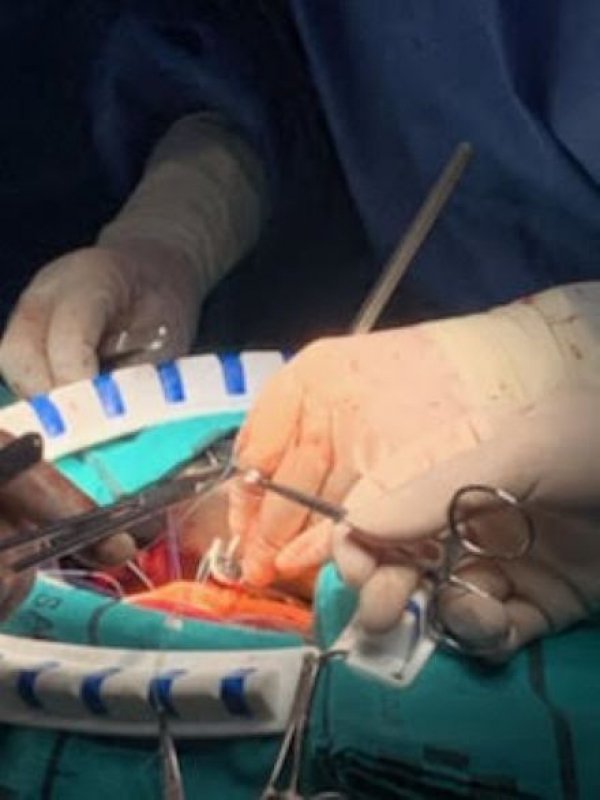 En el HUC Intervención quirurgica cardiaca exitosa, de reparación de válvula aórtica implantando Anillo HAART