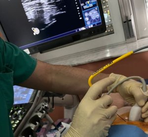 El Hospital La Candelaria aplica una t&eacute;cnica novedosa de crioablaci&oacute;n en doce pacientes con c&aacute;ncer de mama