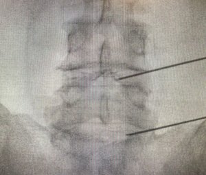 El Hospital Doctor José Molina Orosa incorpora nuevas técnicas ambulatorias para el tratamiento de la hernia discal