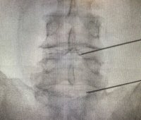 El Hospital Doctor Jos&eacute; Molina Orosa incorpora nuevas t&eacute;cnicas ambulatorias para el tratamiento de la hernia discal
