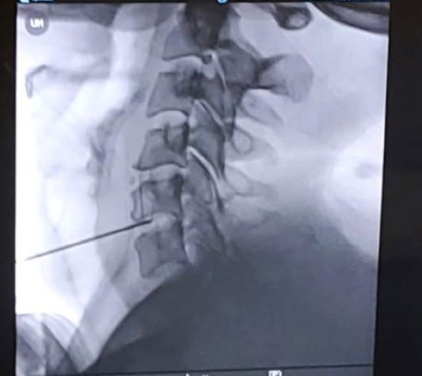 El Hospital de La Palma incorpora una técnica pionera en Canarias en el tratamiento de hernias cervicales