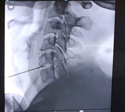 El Hospital de La Palma incorpora una técnica pionera en Canarias en el tratamiento de hernias cervicales