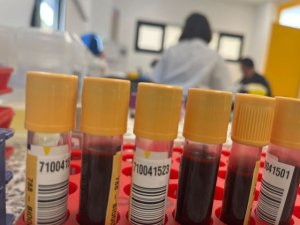 Sanidad comienza a administrar la terapia g&eacute;nica para la Hemofilia B